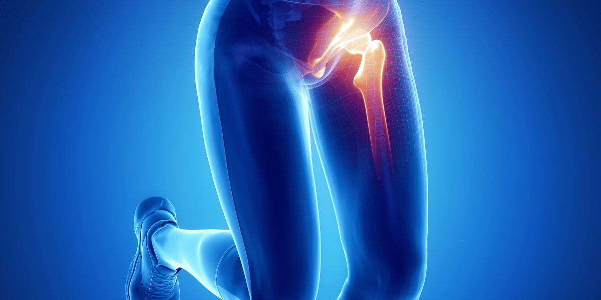 A computer graphic in x-ray style of a runner suffering from hip tendonitis