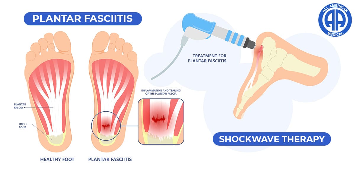 Shockwave Therapy for Plantar Fasciitis Diagram