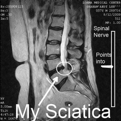 MRI Showing Herniation and Sciatic Pain