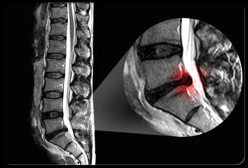 Sciatic Pain Shown IN MRI