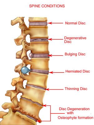 Sciatic Pain Spine Conditions