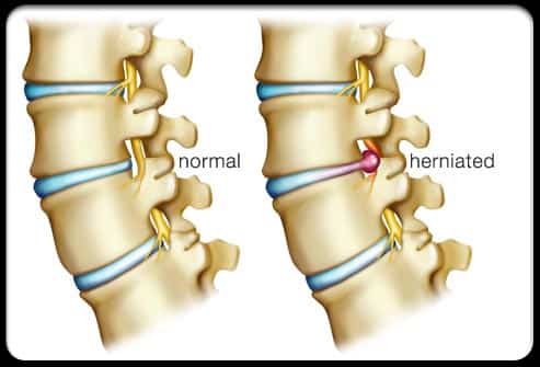 Herniated Compared To Normal Disk