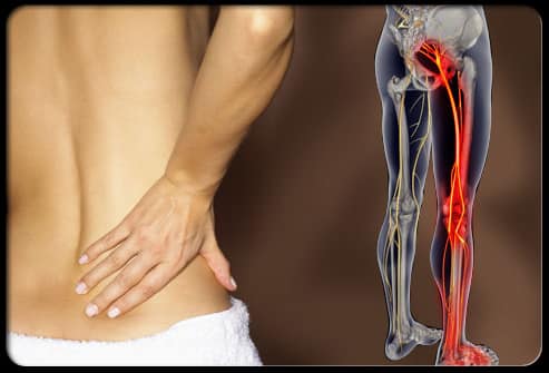 sciatica-s2-photo-of-lower-back-pain1