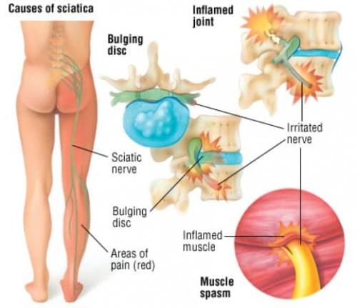 Causes of Sciatic Pain